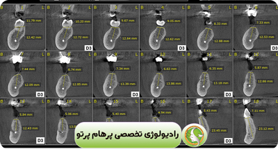 CBCT