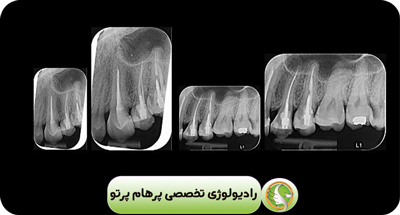 گرافی های داخل دهانی