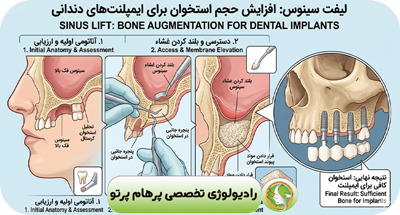 لیفت سینوس چیست؟ اهمیت CBCT قبل از جراحی سینوس لیفت و ایمپلنت